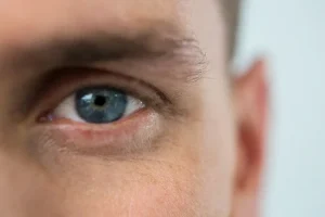 blepharoplasty in turkey