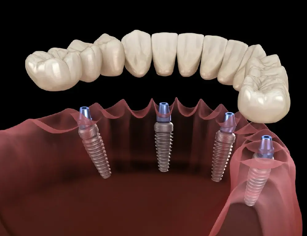 Implantes Dentales en Turquía - Turk Aesthetic İmplantes Dentales en Turquía