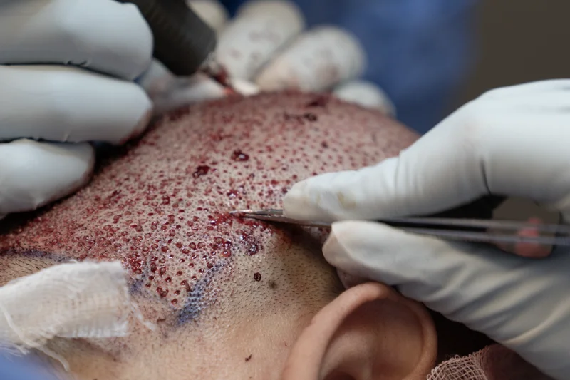 عملية استخراج البصيلات من المنطقة المانحة أثناء زراعة الشعر في تركيا