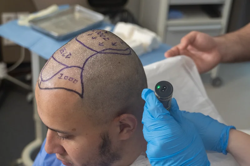 حلاقة المنطقة المانحة في الجزء الخلفي من الرأس قبل زراعة الشعر