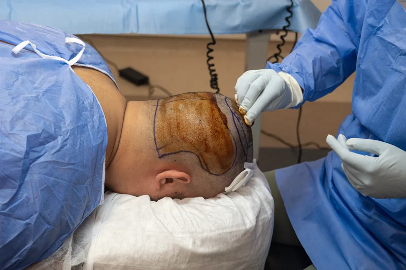 تنظيف وتعقيم المنطقة المانحة قبل زراعة الشعر باستخدام مواد مطهرة