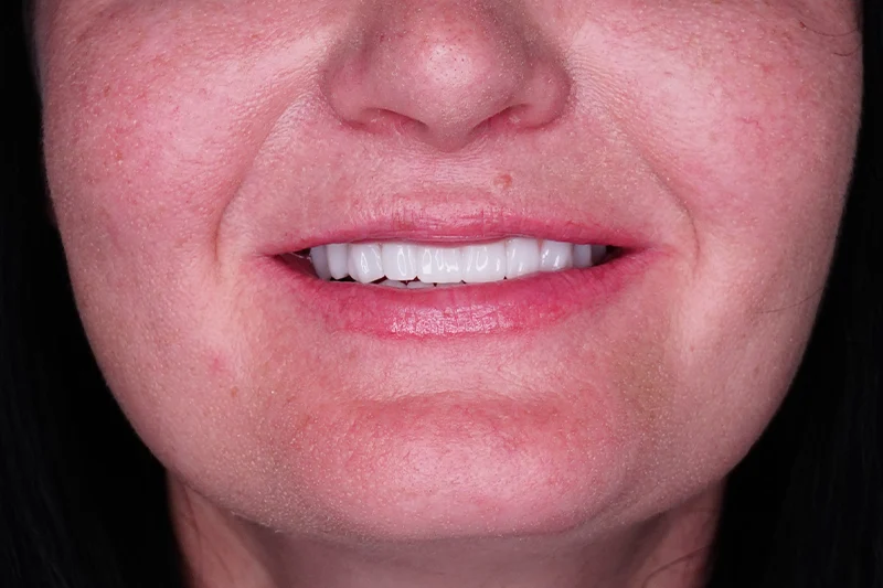 All-on-4 implant tedavisi sonrası sabit diş görünümü
