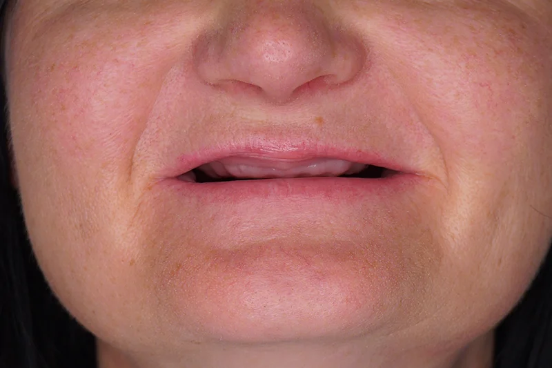 Türkiye’de all-on-4 implant işlemi öncesi dişlerin durumu