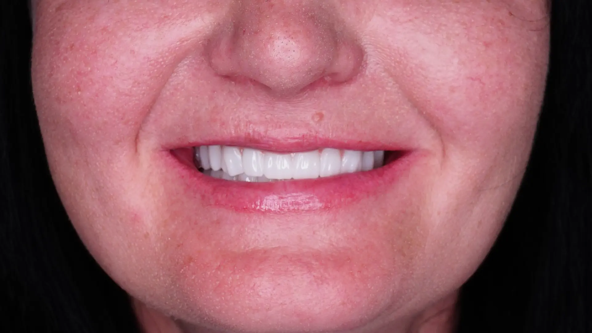 Türkiye’de All-on-4 implant tedavisi