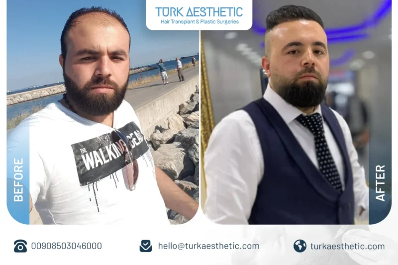 Résultats de la greffe de cheveux DHI en Turquie avant et après avec densité naturelle