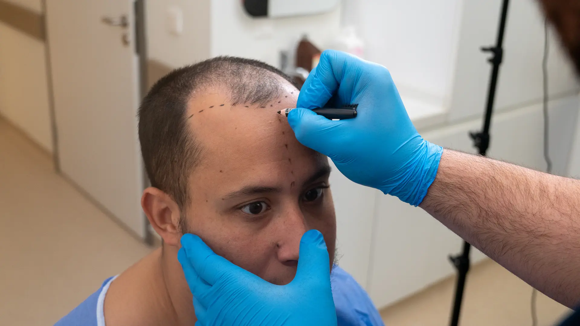 زراعة الشعر بتقنية DHI في تركيا تصميم خط الشعر