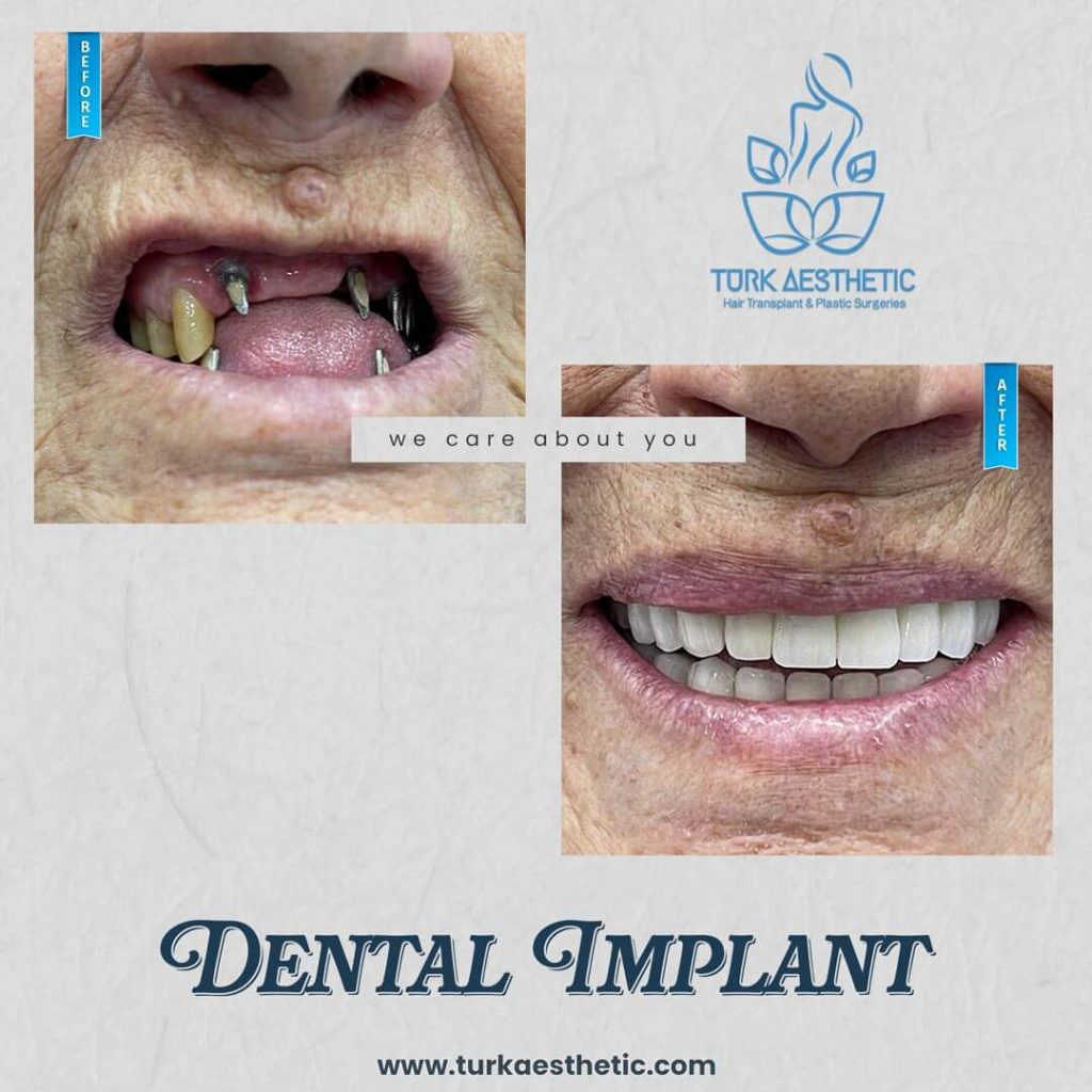 Comment sont réalisés les implants dentaires ? Turkeyana