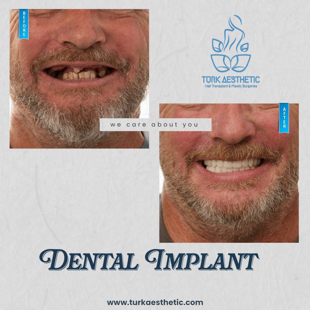 Dental Implant Cost in Turkey - Turk Aesthetic before after dental implant istanbul