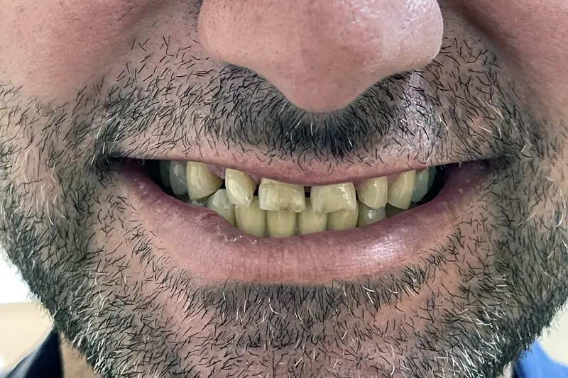 Patient smile after dental implant treatment in Turkey