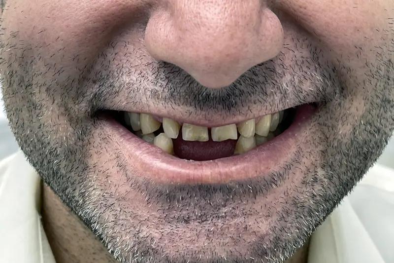 Condition of the teeth before dental implant treatment in Turkey