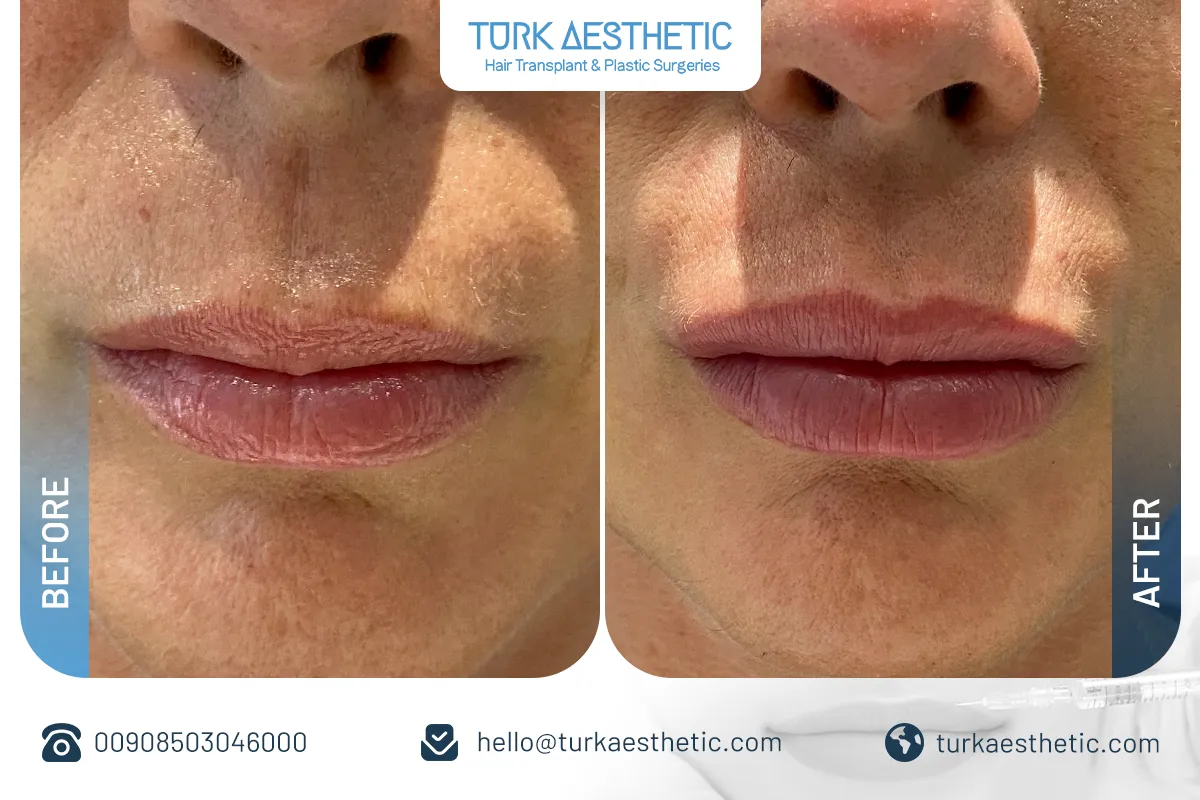 До и после филлеров для губ в Турции