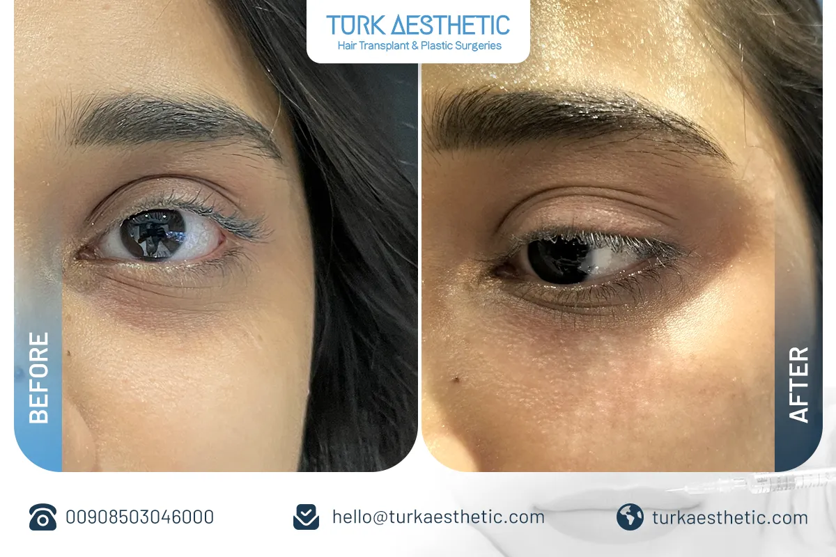 before after light filler in Turkey