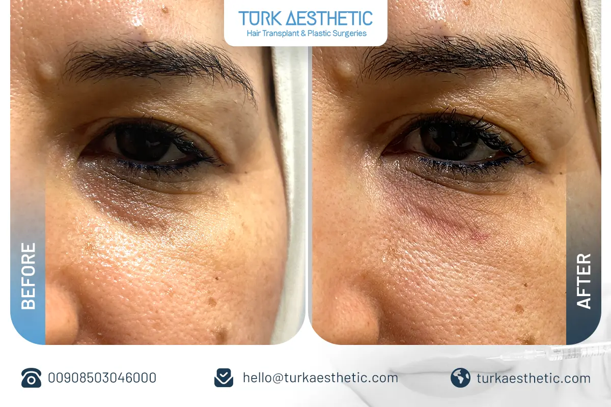 before after light filler in Turkey