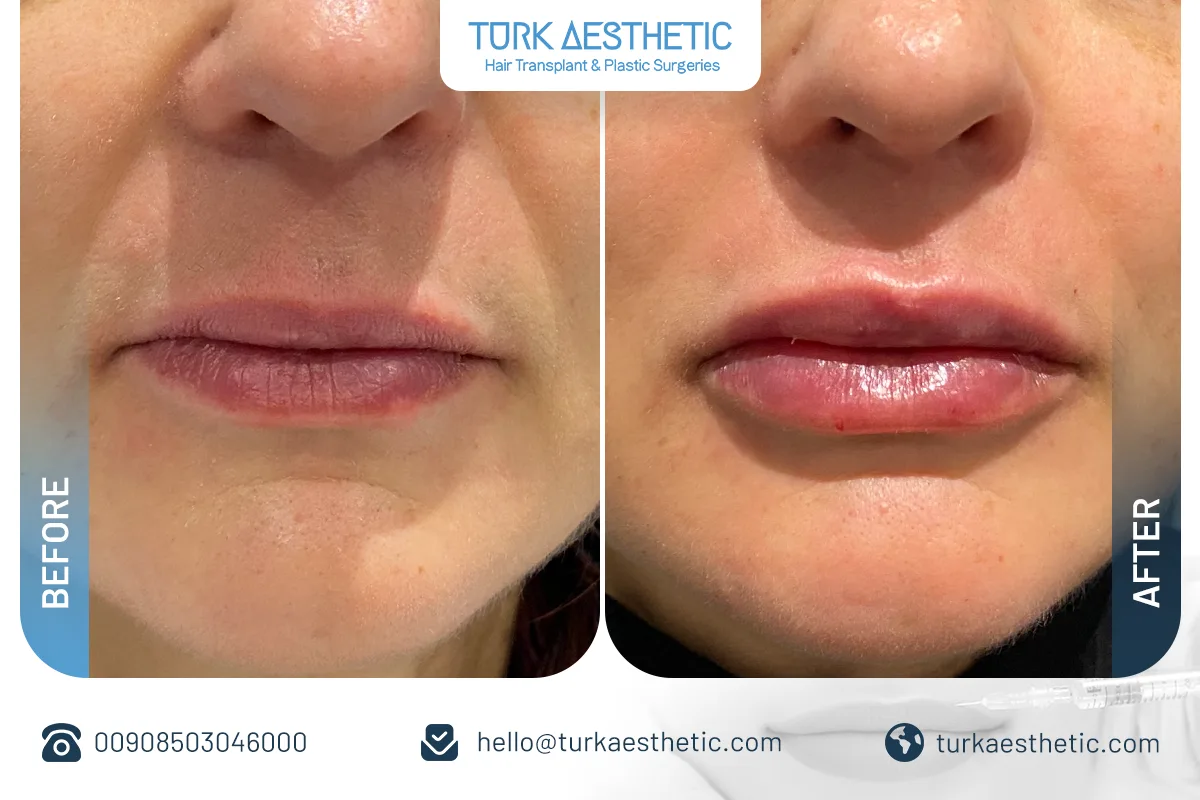 До и после филлеров для губ в Турции