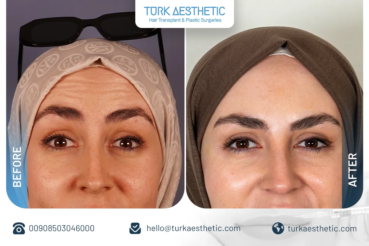 before after botox istanbul turkey