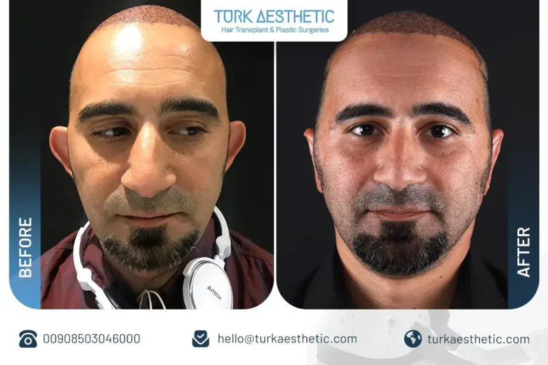 Avant et après l’otoplastie en Turquie et résultats de l’intervention des oreilles