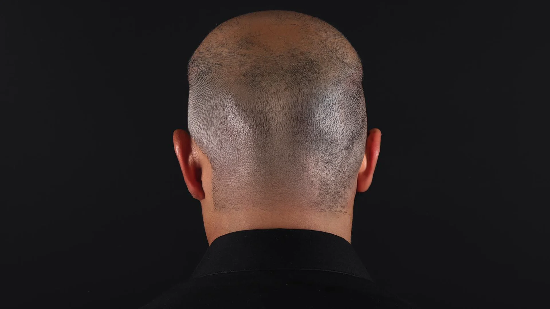 Coût de l’otoplastie en Turquie et prix de l’opération des oreilles à Istanbul