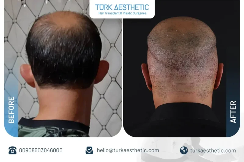 Résultats de l’otoplastie en Turquie et apparence de l’oreille après l’intervention esthétique