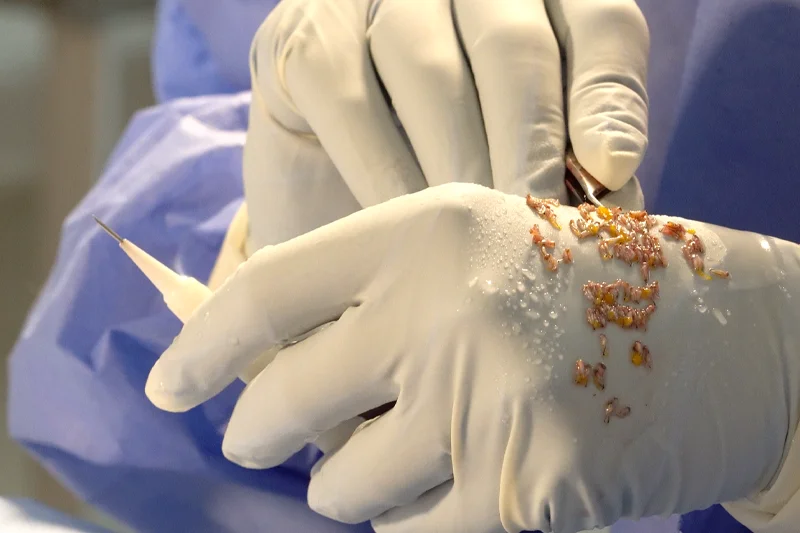 Implantation des greffons lors d’une greffe de cheveux pour femmes en Turquie