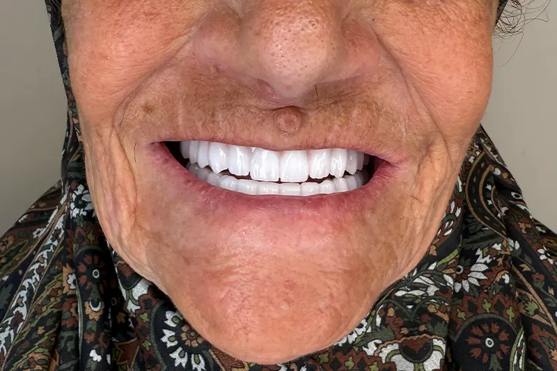 Dents fixes après le traitement All-on-6 en Turquie