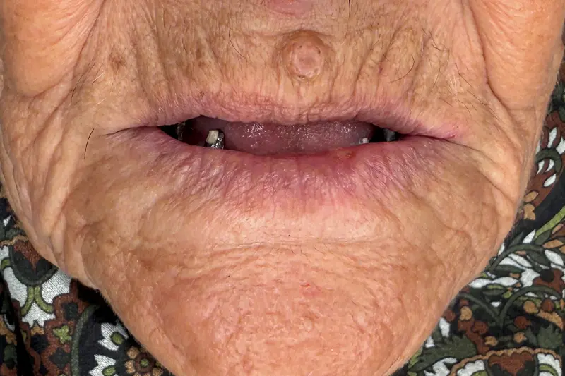 État des dents avant le traitement All-on-6 en Turquie