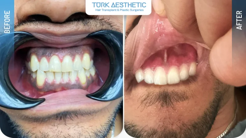 Gum depigmentation before and after