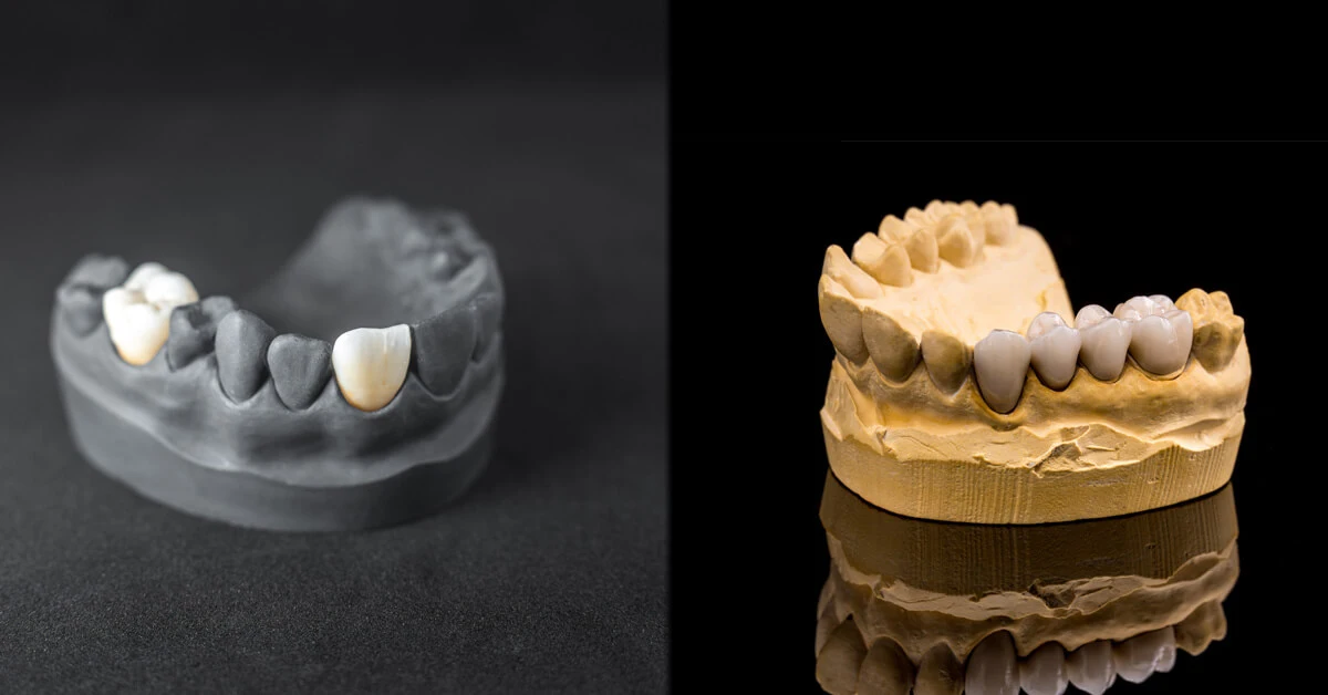 Dental Crown And Dental Bridge
