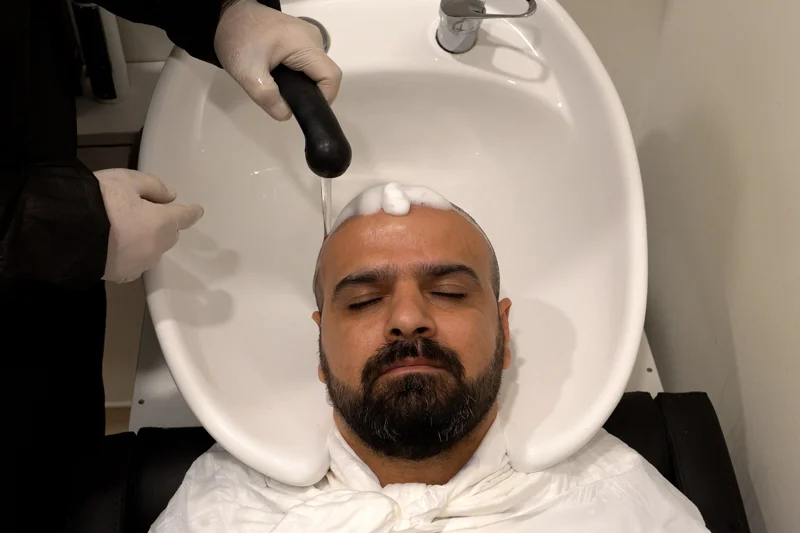 أول غسيل للشعر بعد زراعة الشعر