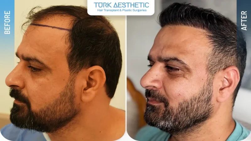 نتائج زراعة الشعر في تركيا قبل وبعد