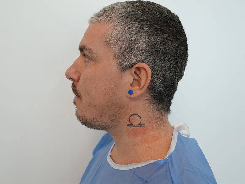 Trasplante de Barba en Turquía - Turk Aesthetic Antes del trasplante de barba