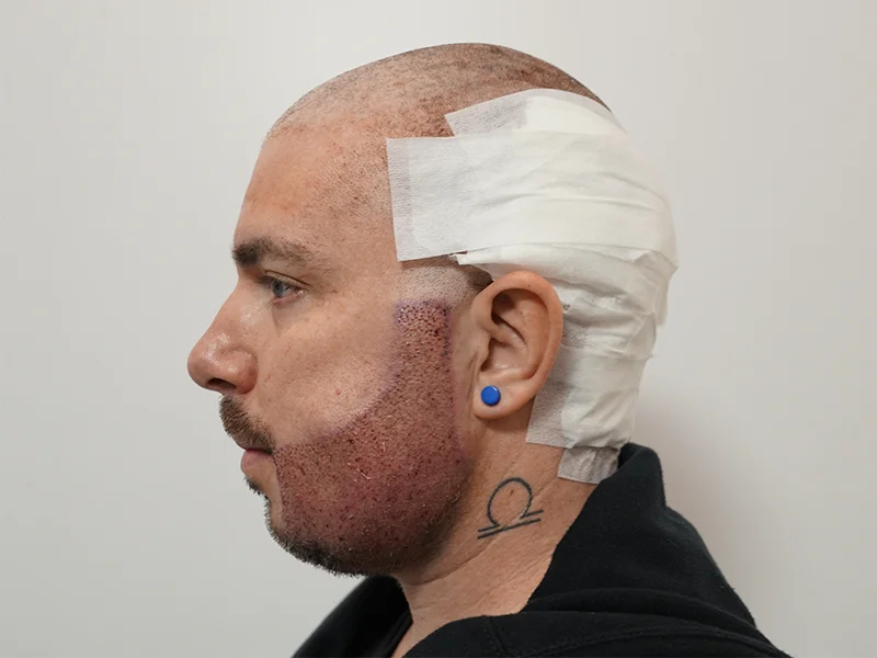 Trasplante de Barba en Turquía - Turk Aesthetic trasplante de barba