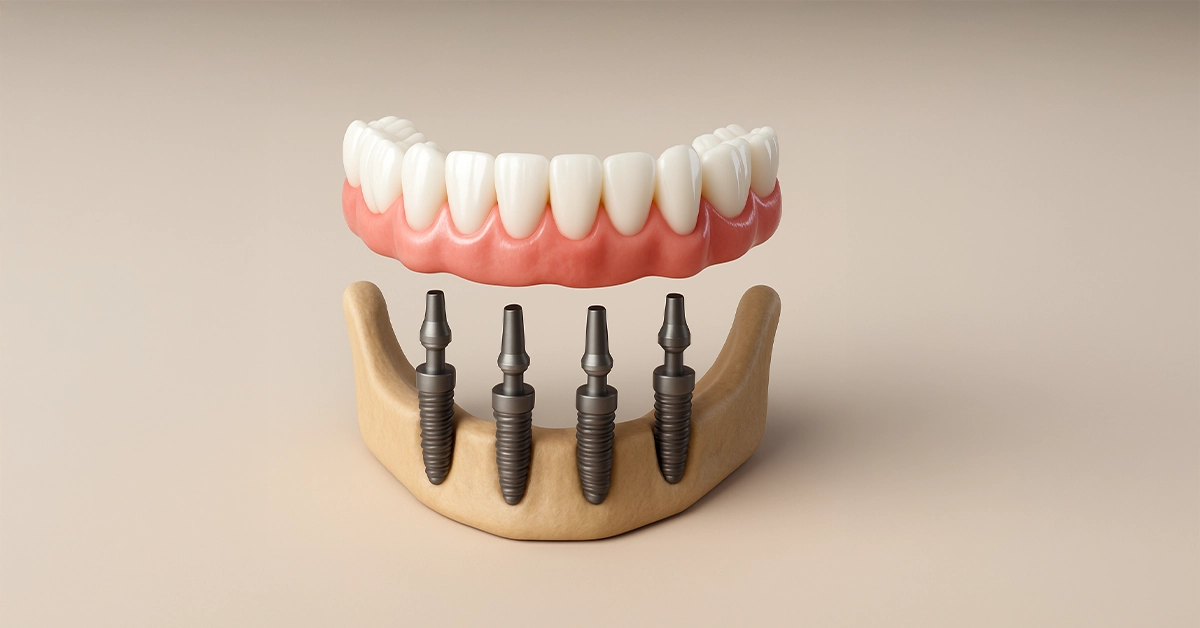 All On 4 implants