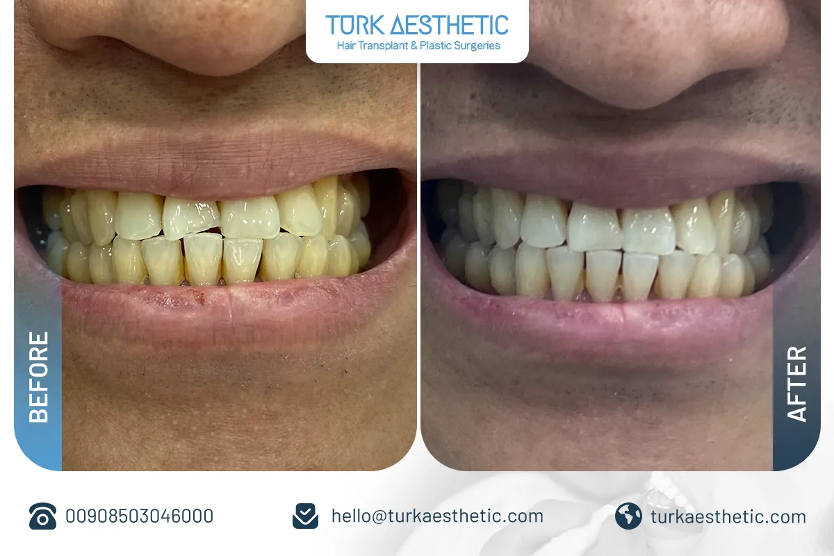 Tratamiento de dientes rotos
