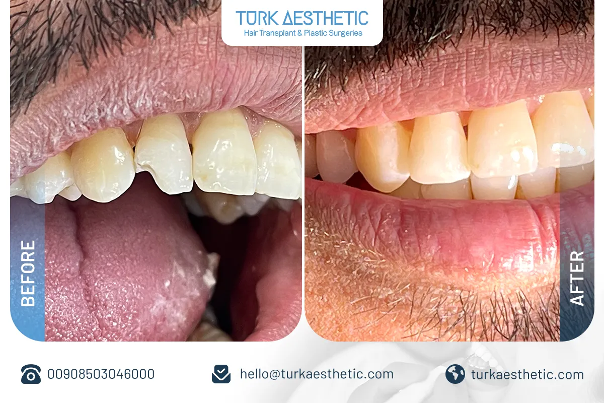 Tratamiento de dientes rotos