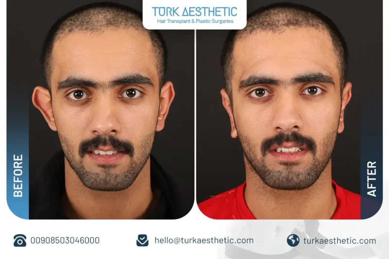 Natural before and after ear surgery results in Turkey