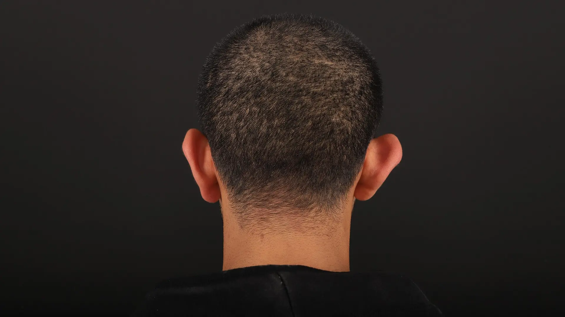 Ear surgery in Turkey with natural results and balanced appearance