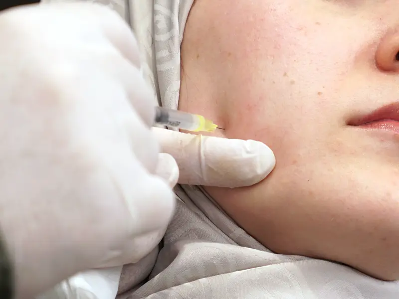 Jaw muscle injection (Masseter)