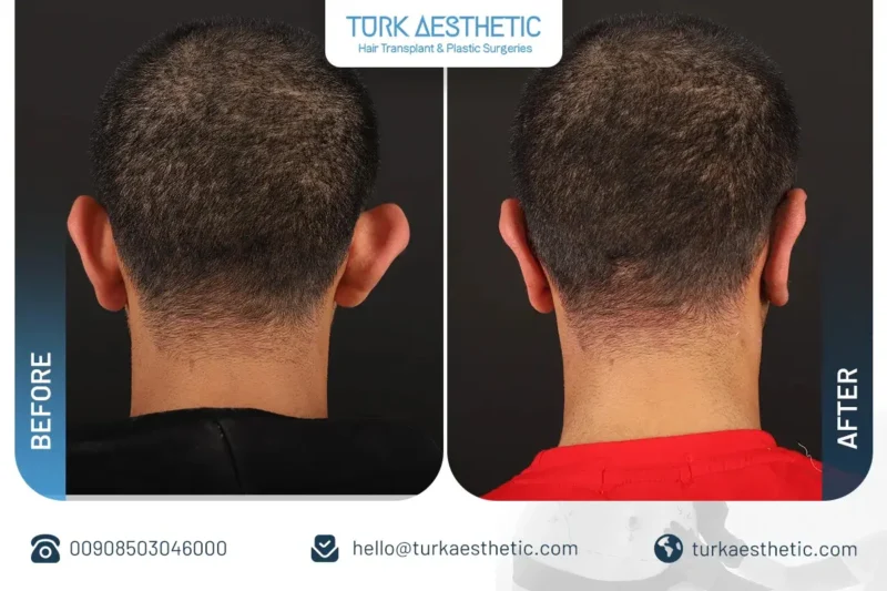 Ear surgery results in Turkey with a natural and balanced appearance