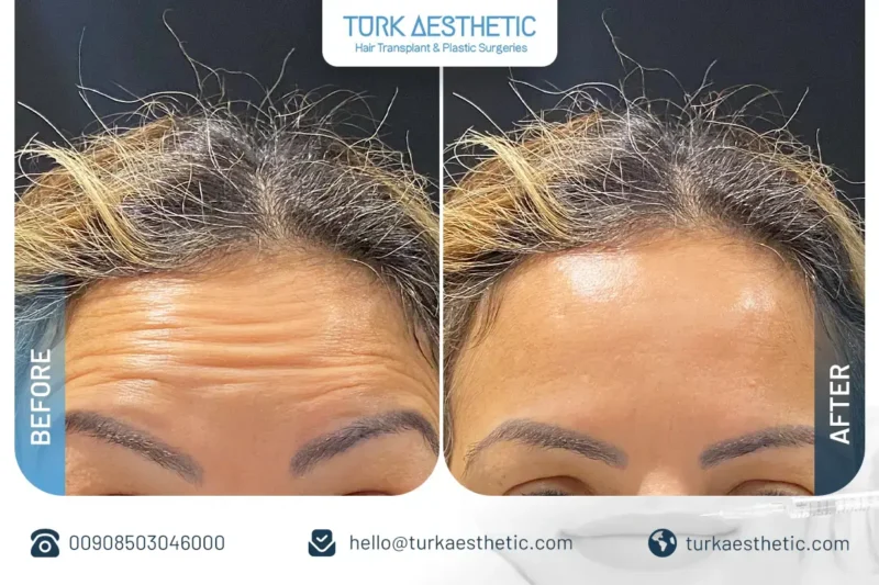 Crow’s feet Botox before and after in Turkey