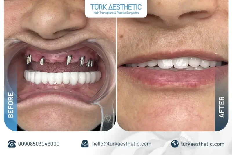 Résultat avant et après traitement par implant dentaire pour remplacer une dent manquante