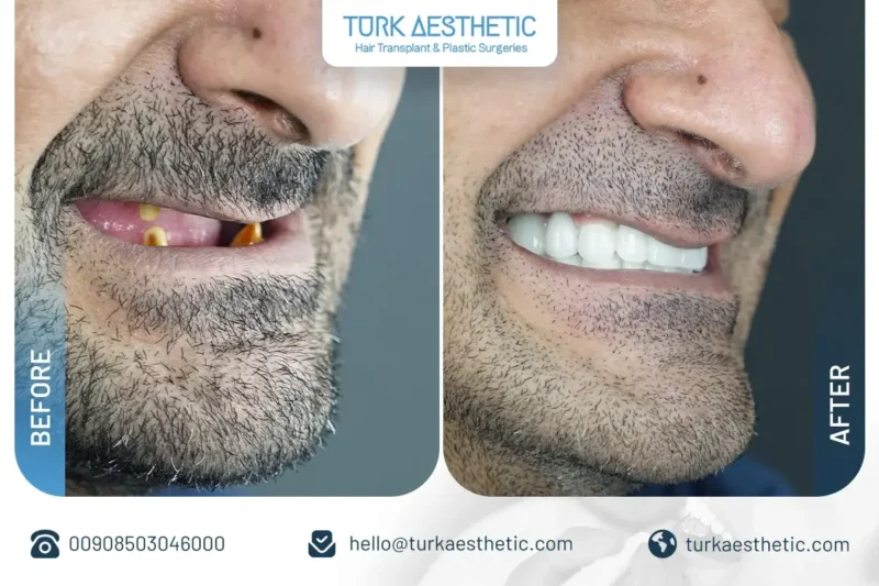 Dental implant treatment outcome Turkey