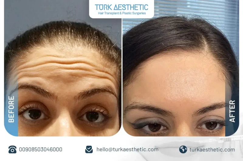 Face Botox before and after in Turkey