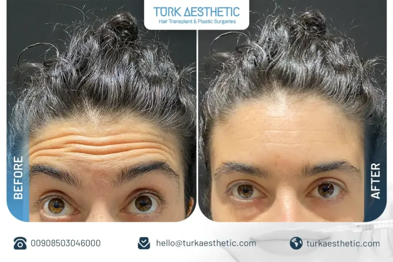 Forehead Botox before and after in Turkey