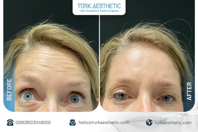 Glabellar Botox before and after in Turkey