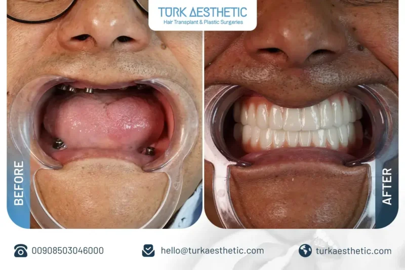 Amélioration du sourire avant et après traitement par implant dentaire