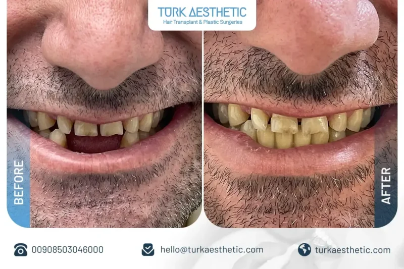 Ergebnisse von Zahnimplantaten vor und nach der Behandlung