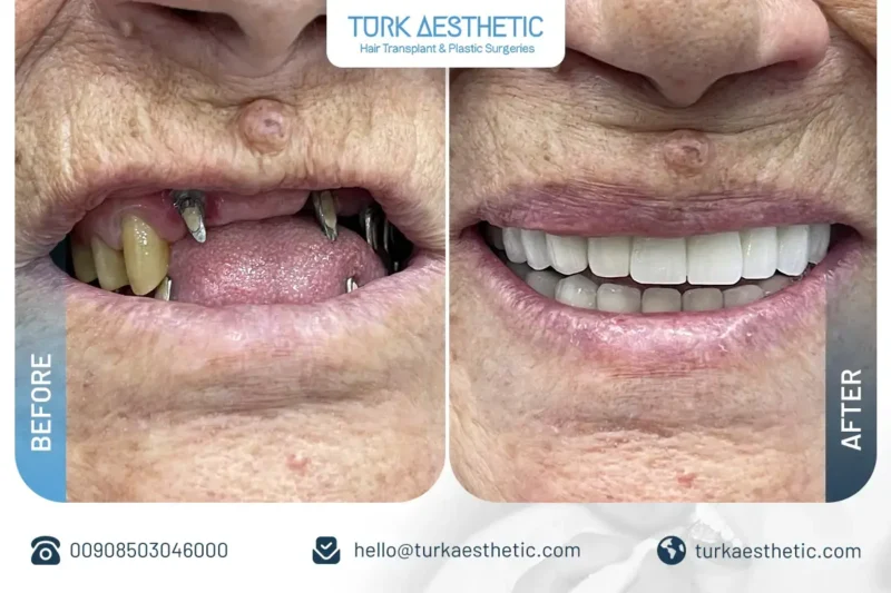 Résultat avant et après procédure d’implant dentaire