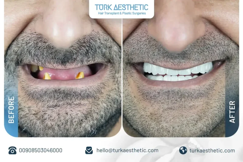Dental implants treatment result in Turkey