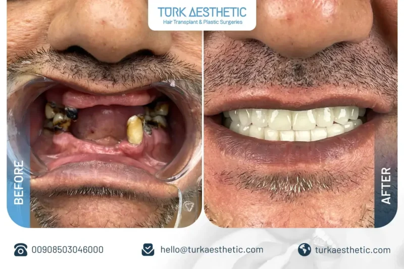 Transformation du sourire avant et après traitement par implant dentaire