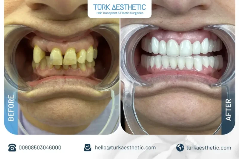 Dental implants before and after in Turkey